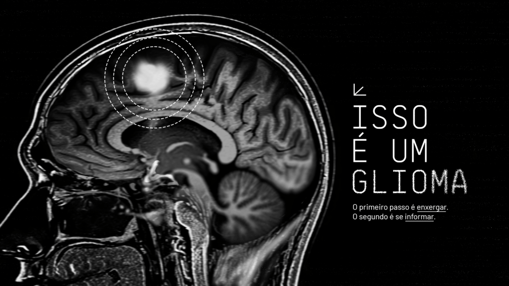 Campanha “Isso é um Glioma” traz informação de qualidade e esperança para pacientes com tumores cerebrais
